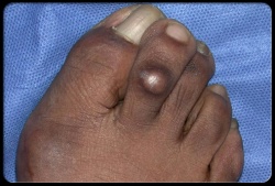 foot hard skin peeler